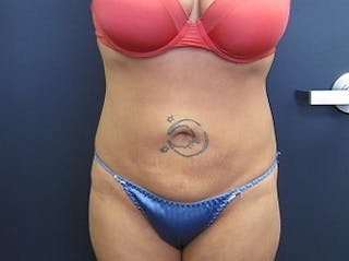 Liposuction Before & After Gallery - Patient 346861 - Image 2
