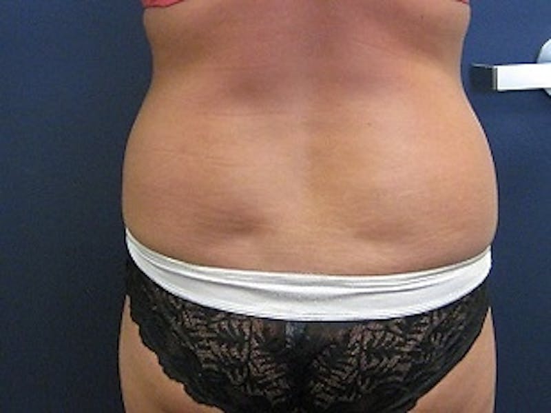 Liposuction Before & After Gallery - Patient 346861 - Image 3