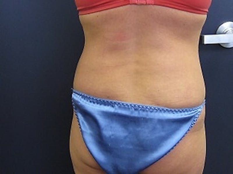 Liposuction Before & After Gallery - Patient 346861 - Image 4