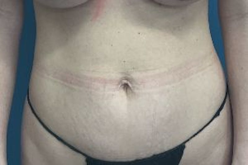 Mini Tummy Tuck Before & After Gallery - Patient 149290 - Image 1