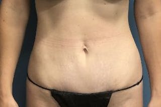 Mini Tummy Tuck Before & After Gallery - Patient 149290 - Image 2
