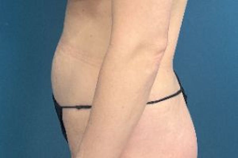 Mini Tummy Tuck Before & After Gallery - Patient 149290 - Image 3