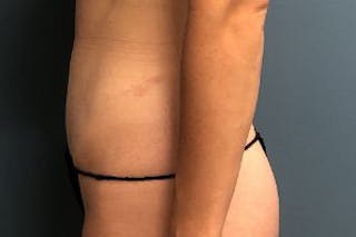 Mini Tummy Tuck Before & After Gallery - Patient 149290 - Image 4