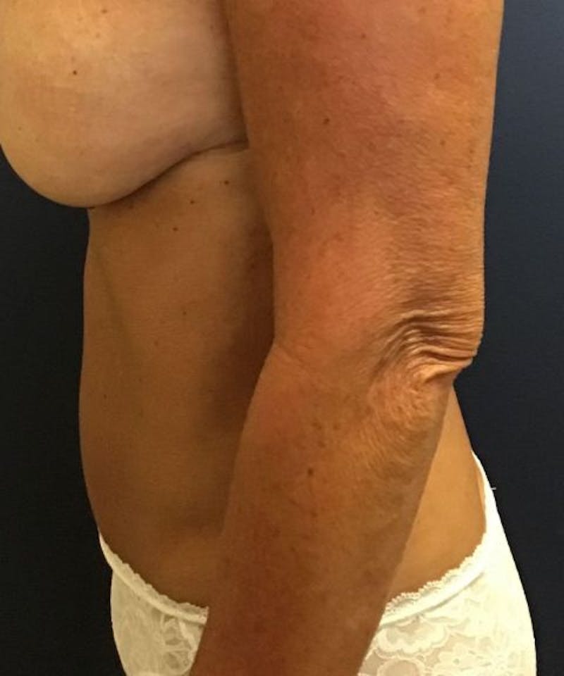 Mini Tummy Tuck Before & After Gallery - Patient 239713 - Image 4