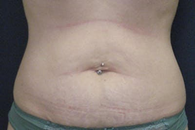 Mini Tummy Tuck Before & After Gallery - Patient 268993 - Image 1
