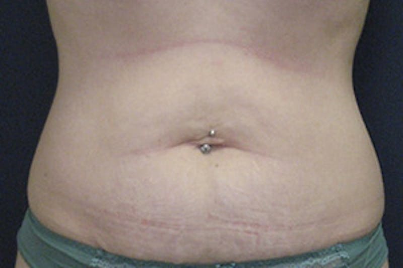 Mini Tummy Tuck Before & After Gallery - Patient 268993 - Image 1