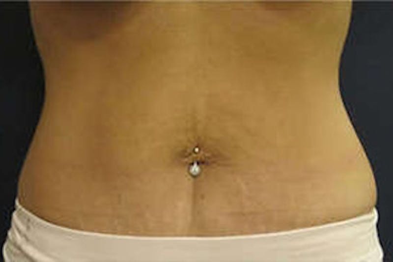 Mini Tummy Tuck Before & After Gallery - Patient 268993 - Image 2
