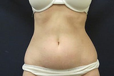 Mini Tummy Tuck Before & After Gallery - Patient 282815 - Image 1