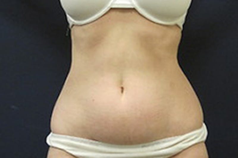 Mini Tummy Tuck Before & After Gallery - Patient 282815 - Image 1