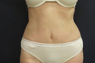 Mini Tummy Tuck Before & After Gallery - Patient 282815 - Image 2