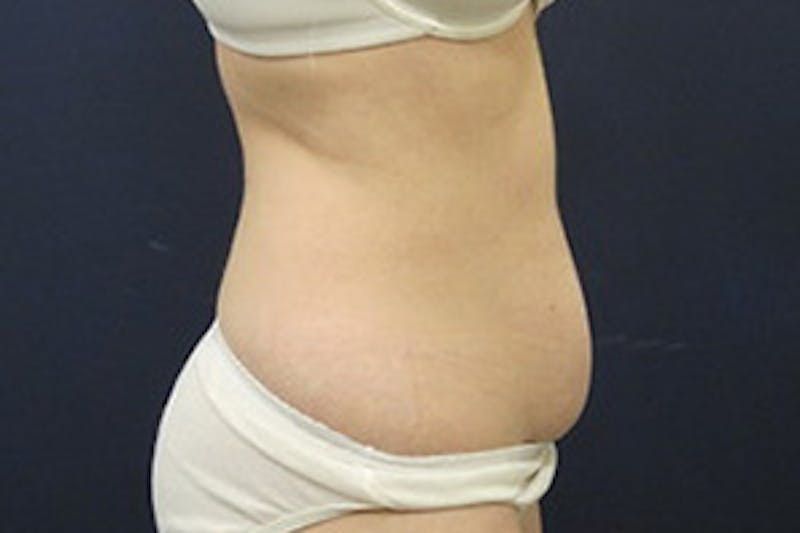 Mini Tummy Tuck Before & After Gallery - Patient 282815 - Image 3