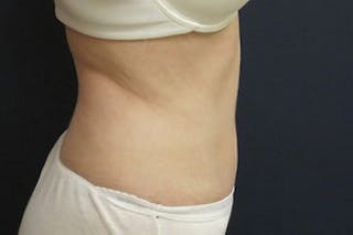 Mini Tummy Tuck Before & After Gallery - Patient 282815 - Image 4