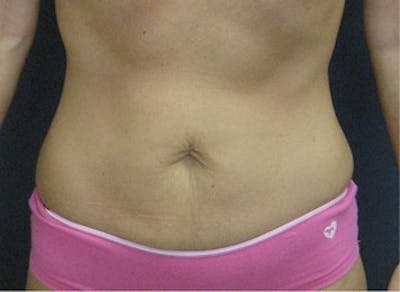 Mini Tummy Tuck Before & After Gallery - Patient 295623 - Image 1
