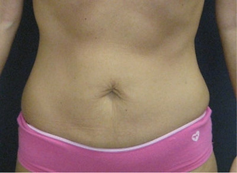 Mini Tummy Tuck Before & After Gallery - Patient 295623 - Image 1
