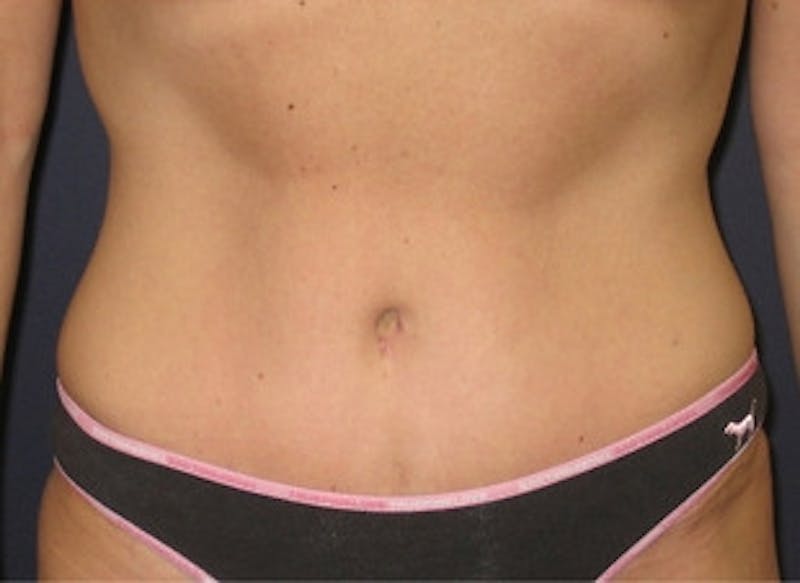 Mini Tummy Tuck Before & After Gallery - Patient 295623 - Image 2