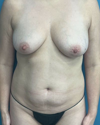 Mommy Makeover Before & After Gallery - Patient 431359 - Image 1