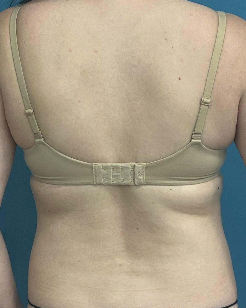 Mommy Makeover Before & After Gallery - Patient 431359 - Image 5