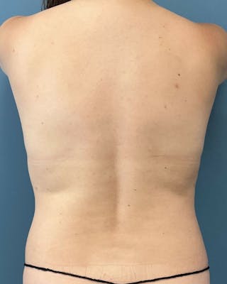 Mommy Makeover Before & After Gallery - Patient 431359 - Image 6