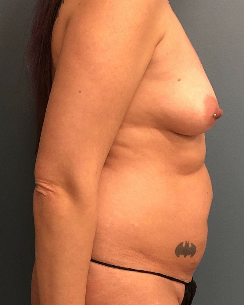 Mommy Makeover Before & After Gallery - Patient 403848 - Image 3