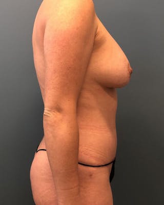 Mommy Makeover Before & After Gallery - Patient 160642 - Image 4