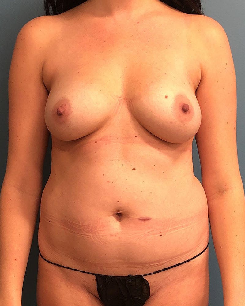Mommy Makeover Before & After Gallery - Patient 108973 - Image 1