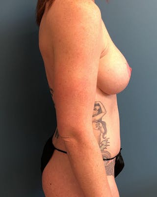 Mommy Makeover Before & After Gallery - Patient 332701 - Image 4