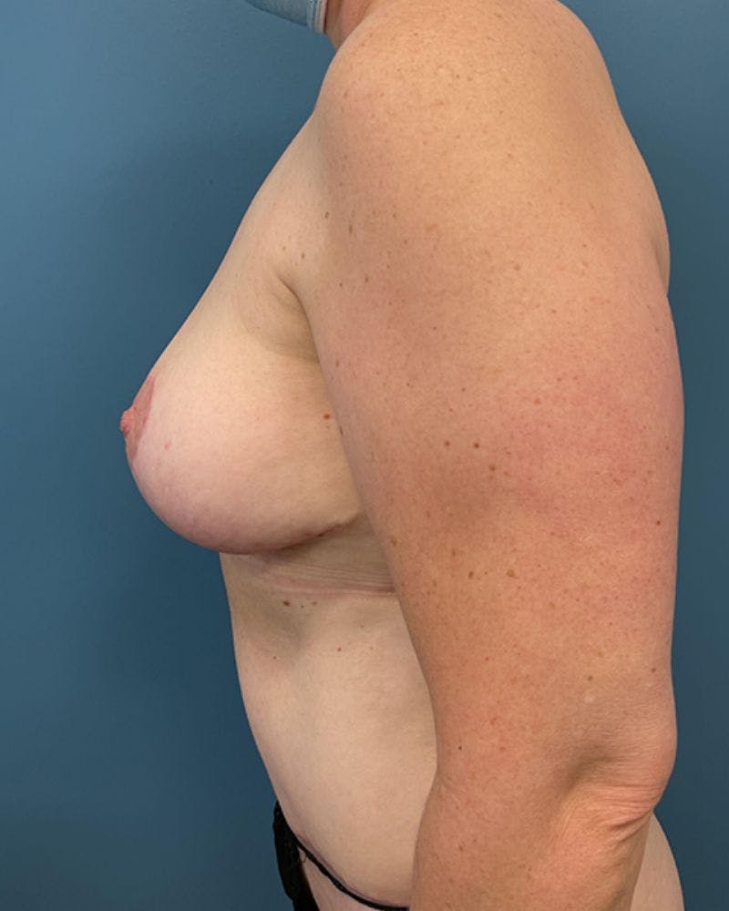 Mommy Makeover Before & After Gallery - Patient 416360 - Image 4