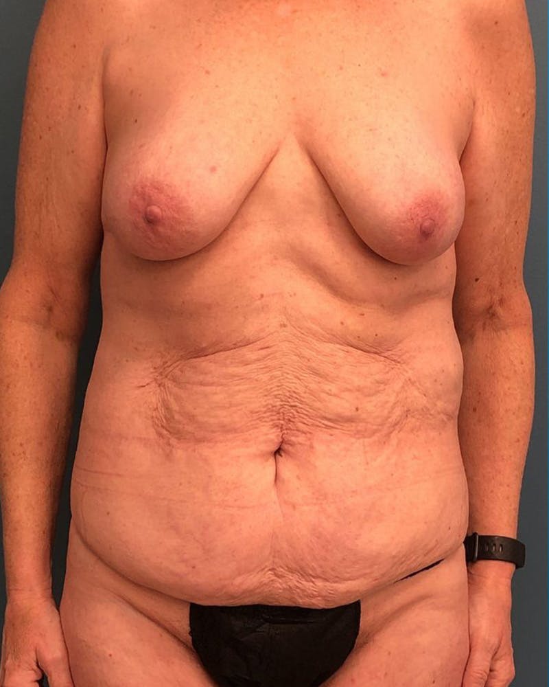 Mommy Makeover Before & After Gallery - Patient 171504 - Image 1