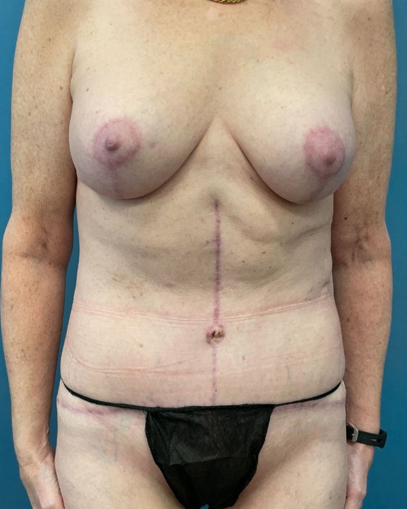 Mommy Makeover Before & After Gallery - Patient 171504 - Image 2