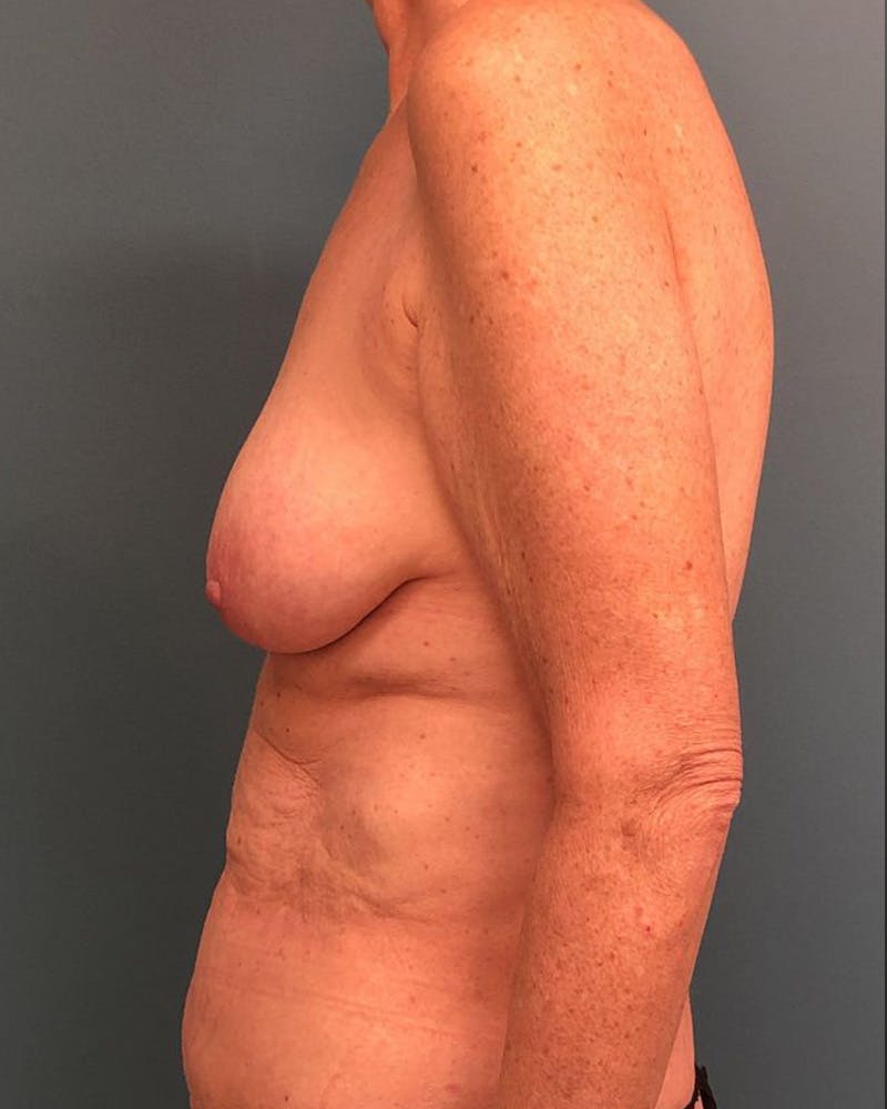 Mommy Makeover Before & After Gallery - Patient 171504 - Image 3