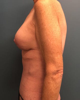 Mommy Makeover Before & After Gallery - Patient 171504 - Image 4