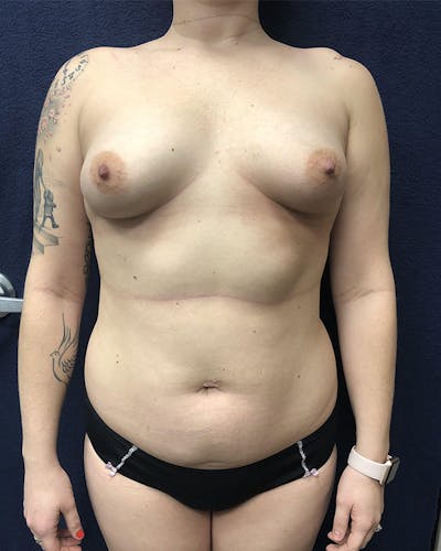 Mommy Makeover Before & After Gallery - Patient 491200 - Image 1