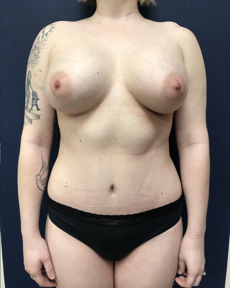 Mommy Makeover Before & After Gallery - Patient 491200 - Image 2