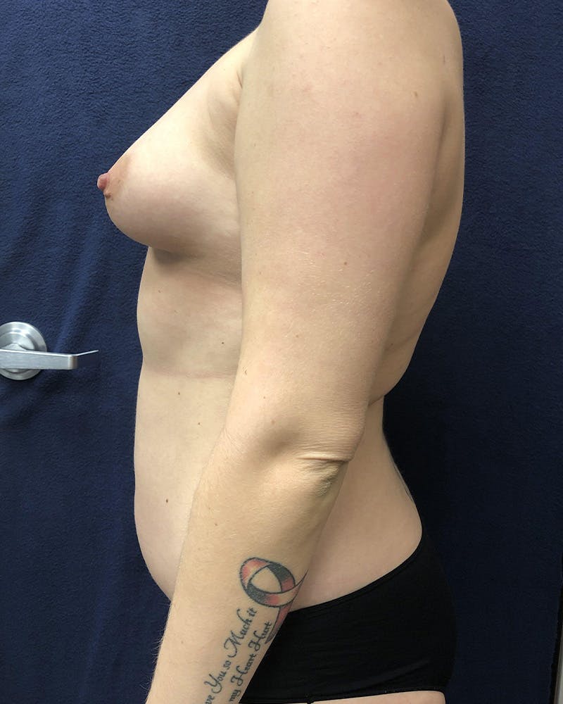 Mommy Makeover Before & After Gallery - Patient 491200 - Image 3