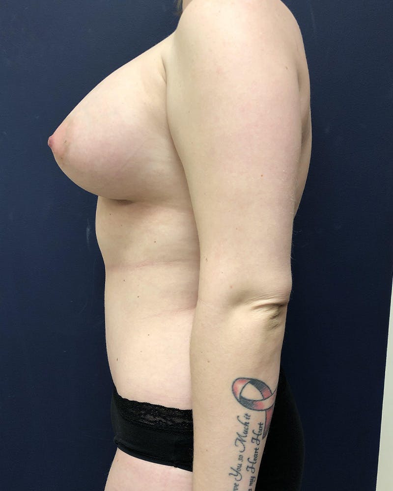 Mommy Makeover Before & After Gallery - Patient 491200 - Image 4