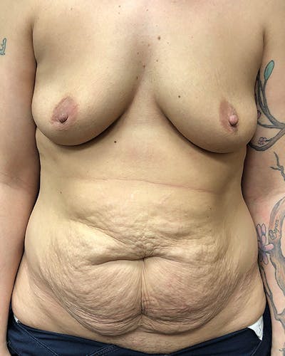 Mommy Makeover Before & After Gallery - Patient 316318 - Image 1