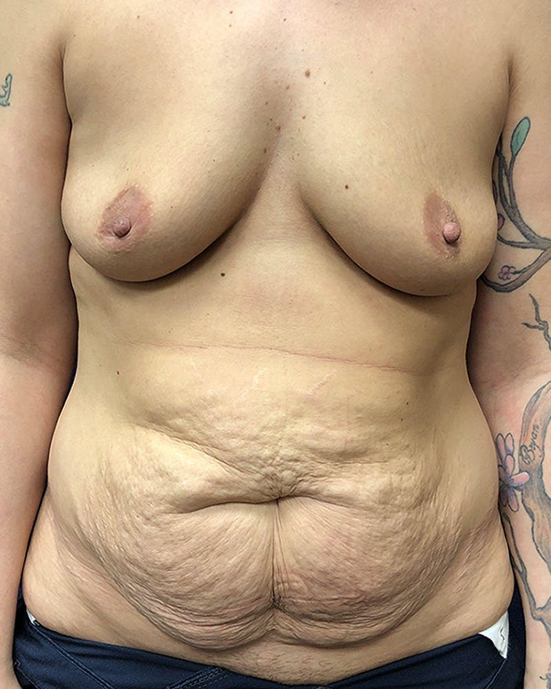 Mommy Makeover Before & After Gallery - Patient 316318 - Image 1