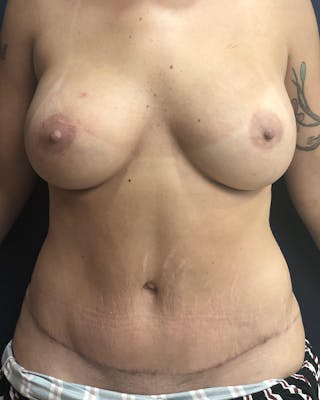 Mommy Makeover Before & After Gallery - Patient 316318 - Image 2