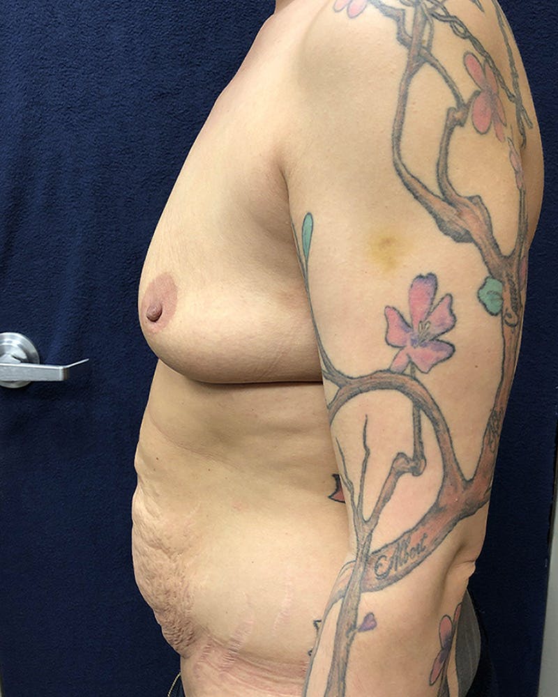 Mommy Makeover Before & After Gallery - Patient 316318 - Image 3