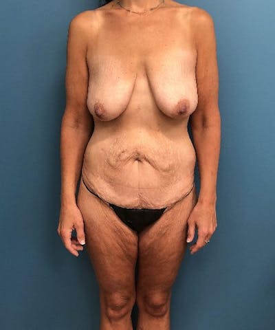 Mommy Makeover Before & After Gallery - Patient 410757 - Image 1
