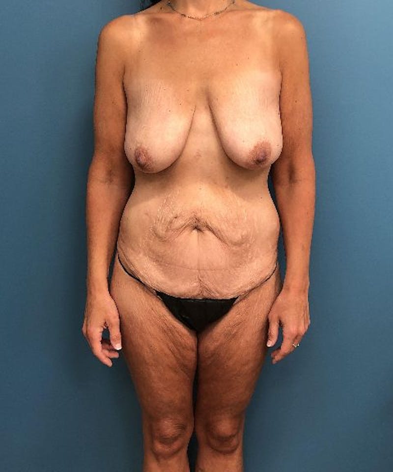 Mommy Makeover Before & After Gallery - Patient 410757 - Image 1