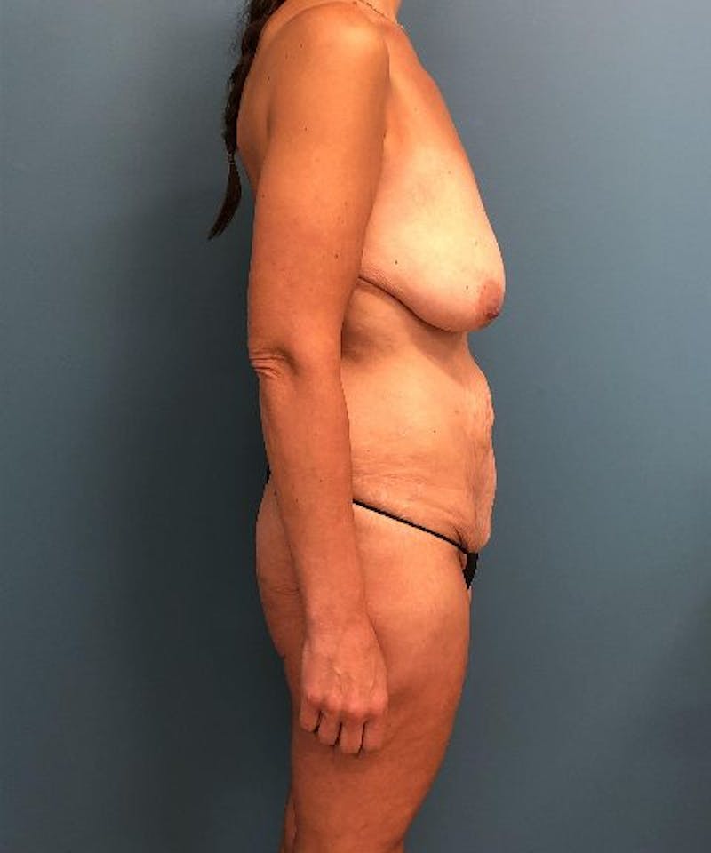 Mommy Makeover Before & After Gallery - Patient 410757 - Image 3