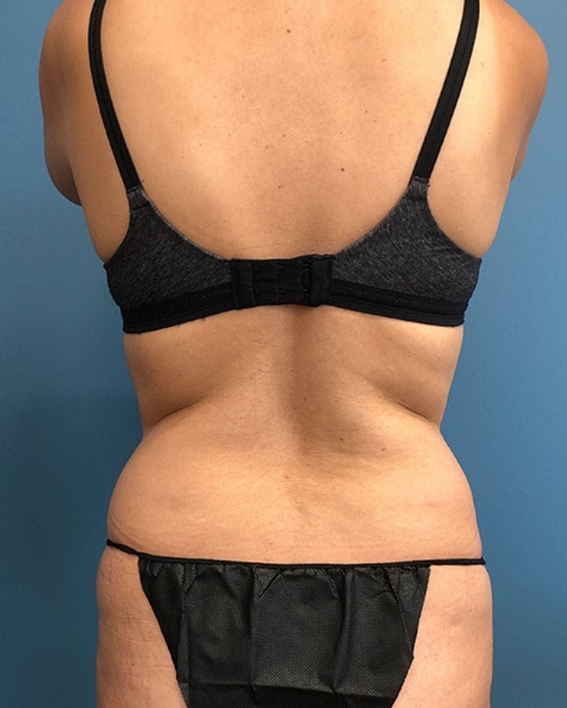 Mommy Makeover Before & After Gallery - Patient 352319 - Image 5