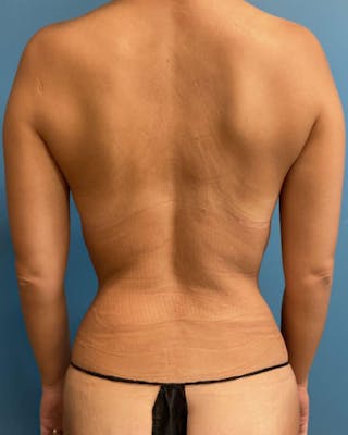 Mommy Makeover Before & After Gallery - Patient 352319 - Image 6