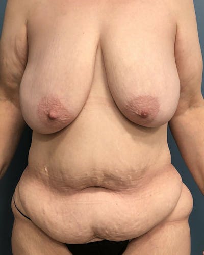 Mommy Makeover Before & After Gallery - Patient 505362 - Image 1