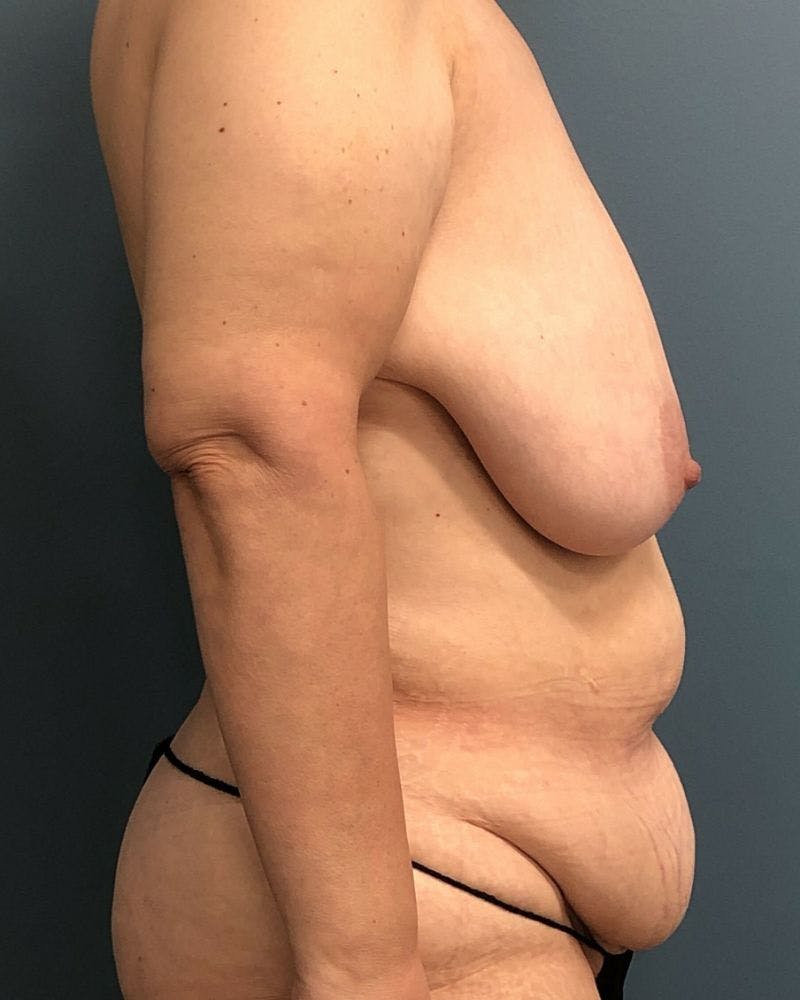 Mommy Makeover Before & After Gallery - Patient 505362 - Image 3