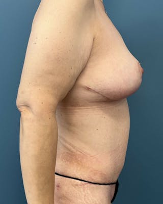 Mommy Makeover Before & After Gallery - Patient 505362 - Image 4