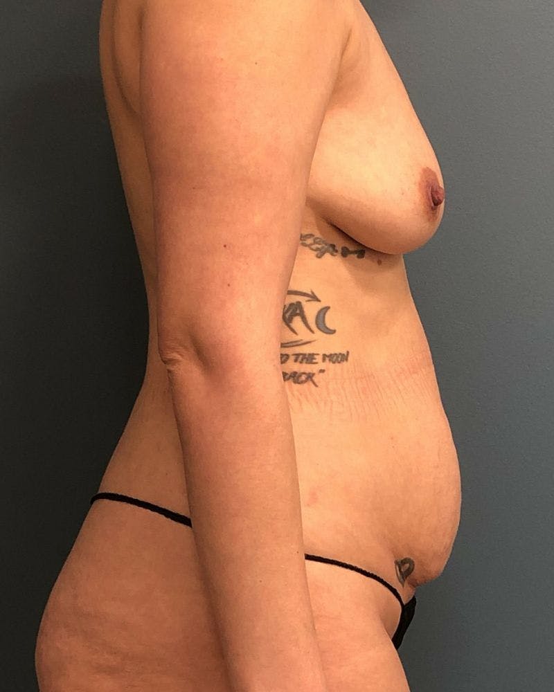 Mommy Makeover Before & After Gallery - Patient 170180 - Image 3