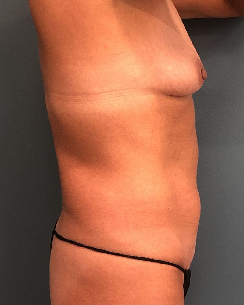 Mommy Makeover Before & After Gallery - Patient 690261 - Image 3
