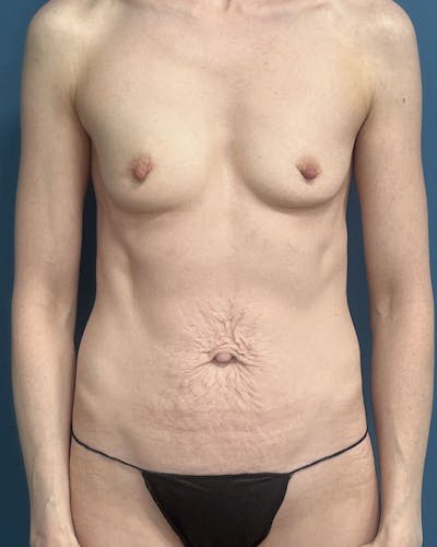 Mommy Makeover Before & After Gallery - Patient 365531 - Image 1